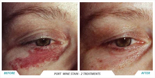 port wine birthmark removal